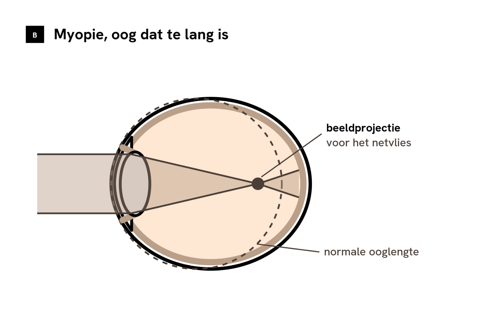 Schema van een oog met myopie: het oog is te lang en het beeld valt voor het netvlies